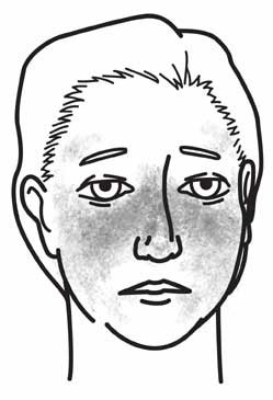 [ woman with lupus ]